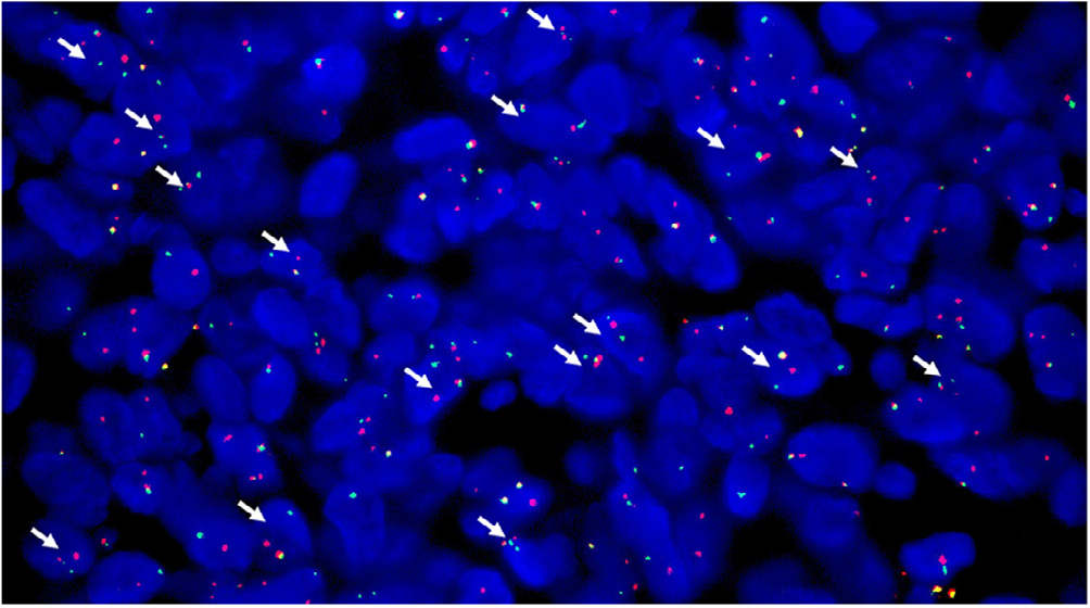 2022, 見刊，GLI1-altered epithelioid soft tissue tumor A newly described entity with a predilection for the tongue-6